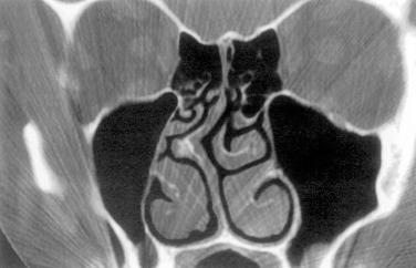 Fig. 1.2, Coronal computed tomographic scan of the sinuses demonstrating a large posterior septal deformity.