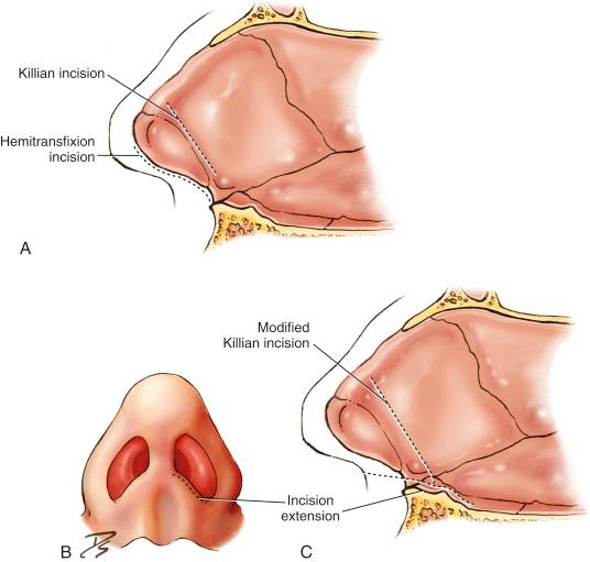 Fig. 1.5, (A) Drawing of standard hemitransfixion incision and Killian incision. (B) Inferior view modified Killian incision. (C) Sagittal view modified Killian incision.