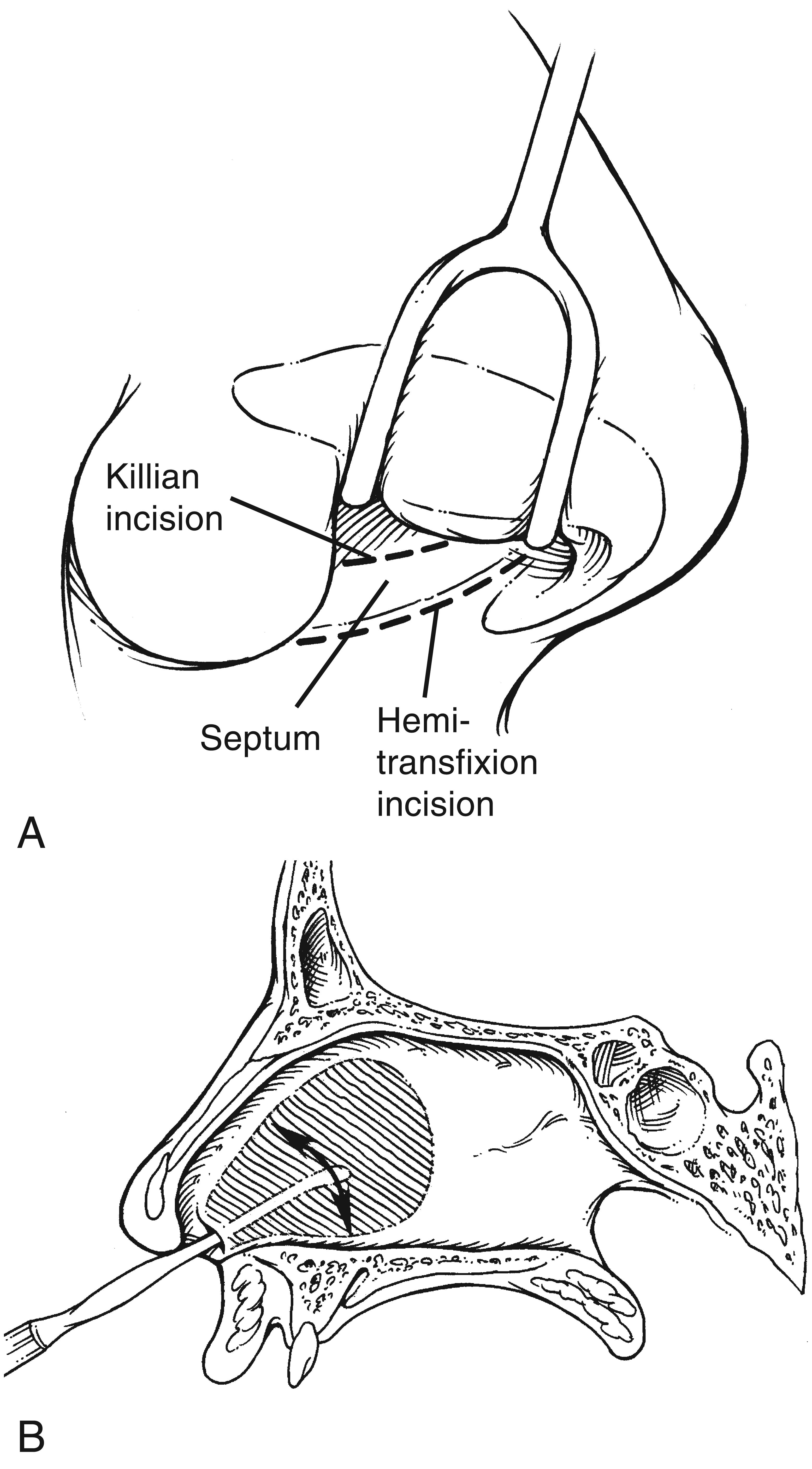 Fig. 28.1, A, B. Various approaches to the nasal septum when performing a septoplasty.