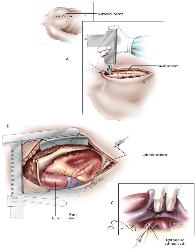 Figure 2-1, A A midsternal incision is made for nearly all cardiac operations. The exceptions are operations on the branch pulmonary arteries or the thoracic aorta, such as palliative procedures in which a thoracotomy is used. The midsternal incision begins below the sternal notch over the sternal manubrium and extends to the xiphoid process. Low, short incisions are preferred for cosmetic reasons and should be used unless they would limit exposure of the heart. The incision is taken through the periosteum of the anterior table of the sternum using electrocautery dissection. A thyroid retractor is inserted to gain exposure of the upper end of the sternum, and a right-angled clamp is used to open the mediastinum behind the sternum. The sternal saw is tested for proper operation before placing it against the upper end of the sternum. The sternal saw is grasped firmly with the thumb at the top and the fourth and fifth fingers at the back and bottom so that the saw blade can be held firmly against the sternum and the saw’s protective “toe” guard is forced against the posterior table of the sternum. Ventilation of the patient is stopped momentarily to allow the lungs to deflate and retract away from the anterior chest wall as the sternum is divided with the saw. It is usually advisable to back up the saw once or twice during division of the sternum to release mediastinal tissue that may be caught up in the instrument; this permits the pleura to be left intact. The sternal edges are separated initially with a thyroid retractor, and hemostasis is obtained using electrocautery with a ball-tipped electrode and a thin layer of bone wax or Gelfoam reconstituted with antibiotic solution. B The sternal retractor is used to separate the sternal edges for optimal exposure of the heart. The pericardium is opened in the midline, and retraction stitches are placed to gain access to the heart. The pericardium is cut back to the full extent of the reflection off the aorta superiorly and onto the diaphragm inferiorly. Extension of the pericardial incisions inferiorly to the right or left toward the pleural spaces may be required to expose the lower aspects of the right atrium or the apex of the heart. Retraction stitches of 2/0 silk are placed from the pericardium to the subcutaneous tissues or the retractor. The aorta, right ventricle, pulmonary artery, and right atrial appendage are clearly in view and freely accessible. The left ventricle, left atrium, and lower aspects of the right atrium must be exposed by retraction or displacement of the heart. C Placement of a small vinyl catheter for monitoring the left atrial pressure is the initial step of the setup for cardiac surgery. The right atrium is retracted to expose the right superior pulmonary vein. A box stitch is placed in the pulmonary vein using 4/0 polypropylene suture. A needle with a catheter is used to enter the pulmonary vein within the box stitch, and the catheter is advanced precisely for a measured length so that the catheter tip is located just inside the left atrium. The needle is withdrawn, and the catheter is secured by tying the box stitch and making an additional stitch of 5/0 silk through the pericardium around the catheter. The catheter is brought out through the skin to the left of the skin incision.