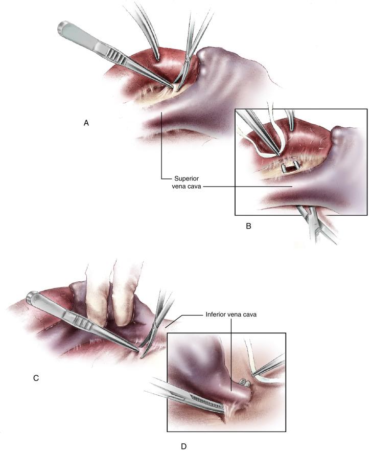 Figure 2-2, A The pericardium over the anterior aspect of the right pulmonary artery just medial to the superior vena cava is opened. B Exposure of this area is enhanced by retraction of the aorta anteriorly and to the left. A right-angled clamp is passed behind the superior vena cava from its lateral aspect. The pericardial reflection lateral to the cava is usually thin and can be easily and safely perforated as it is invaginated toward the incision medially and anterior to the right pulmonary artery. Umbilical tape or heavy No. 3 silk suture is passed around the vena cava and through the polyethylene catheter tourniquet. C Similar steps are used to control the inferior vena cava. The pericardium is incised in the space between the inferior pulmonary vein and the inferior vena cava. The pericardium may be quite thick in this area, so it is safer to use a sharp incision rather than forceful blunt dissection to obtain access to the delicate tissues posterior to the cava. D A right-angled clamp is passed posterior to the inferior vena cava from the lateral aspect. The tip of the clamp can be seen as it emerges from behind the cava on the medial aspect by retracting the diaphragmatic surface of the heart superiorly. This maneuver usually upsets the hemodynamics considerably, so it should be performed efficiently but without compromising accurate exposure of the vena cava. The clamp is used to perforate the thin layer of pericardium medially and make an opening behind the vena cava large enough to draw the tourniquet tape safely around the vena cava.