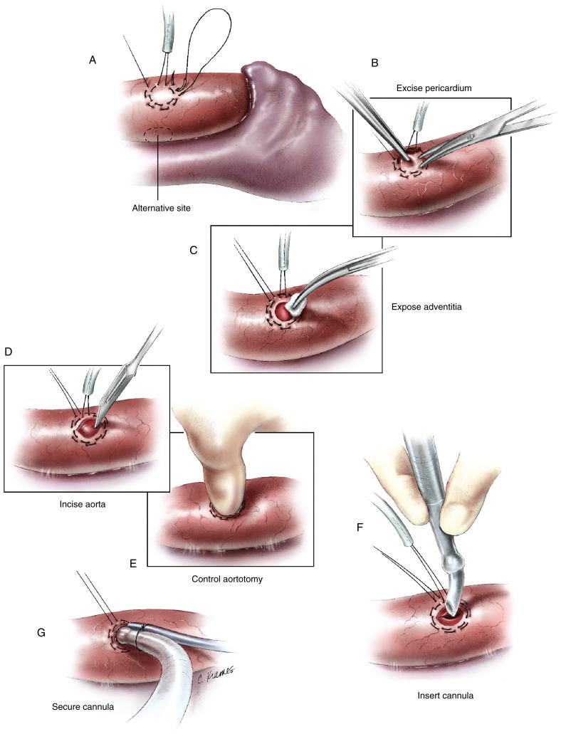 Figure 2-3, A The aorta is prepared for cannulation by placing a purse-string stitch on the anterior aspect near the pericardial reflection. Polypropylene 3/0 suture material and a small needle are used exclusively for purse-string construction because the frequency of aortic perforation is reduced, bleeding around the cannula is less than with braided suture material, and closure of the aorta after removal of the cannula is more secure so that reinforcing pledget material is seldom required. The stitches are placed through the pericardial layer and into the adventitia of the aorta but should not penetrate the lumen of the aorta. Thus, the purse string is located in loose and mobile tissue that is nevertheless strong and will firmly hold the cannula in the aorta and close the aortic incision securely when the purse string is drawn up later. If the needle inadvertently penetrates the aorta, the entire suture should be removed and a new one placed. Stitches that are left in the fixed tissues of the aortic wall are likely to tear through when the purse string is drawn up, leaving an even larger hole in the aorta rather than sealing it. A tourniquet is placed on the purse-string stitch to secure the cannula after it is placed in the aorta. A second stitch is placed immediately outside the first one for added security, but a tourniquet is not necessary. An alternative cannulation site on the right lateral aspect of the aorta may be used if greater access to the anterior wall of the aorta is desired. B The pericardium inside the purse string is removed to expose the aortic wall. This excision removes any loose tissue that could interfere with smooth passage of the aortic cannula into the lumen. C Care must be taken not to mobilize or undermine tissue that is actually supporting the purse string. The area inside the purse string may be cleaned with a Kuettner sponge to remove blood or bits of loose tissue for accurate visualization of the cannulation site. D The size of the cannulation site and the diameter of the surrounding purse string should be 4 to 5 mm larger than the diameter of the cannula to be introduced. A No. 11 blade is used to incise the aorta. The tip of the blade is placed inside the purse string, with the noncutting edge of the blade directed toward the outside. The blade is used to perforate the aorta to a depth sufficient to create an incision equal to the diameter of the cannula to be inserted. Not much blood escapes, provided that the blade is kept absolutely straight and is not allowed to twist. E The thumb of the opposite hand is used to cover the aortic incision to control hemorrhage after the blade is removed from the aorta. Alternatively, the adventitia at the edge of the purse string can be grasped with forceps and pulled toward the aortotomy to control hemorrhage. F The bevel of the aortic cannula is aligned with the aortic incision, the thumb is slid aside or the adventitia is pulled open with the forceps, and the cannula is inserted. Cannulae with removable, tapered point introducers aid the insertion process. Occasionally, the incision in the aorta is not adequate, or loose tissue has been drawn in that interferes with insertion of the cannula. Under these circumstances, the thumb is simply replaced to control hemorrhage while a tonsil clamp is passed beneath the thumb and into the aorta to dilate the opening. This dilation is usually sufficient to allow the cannula to be inserted. If this fails or the hemorrhage cannot be controlled, a partial-occlusion clamp can be placed for better control and assessment of the situation. G The purse-string tourniquet is tightened to achieve hemostasis around the cannula. The cannula is secured to the aorta by simply tying the tourniquet to the cannula. The perfusion tubing is secured to the patient drapes.