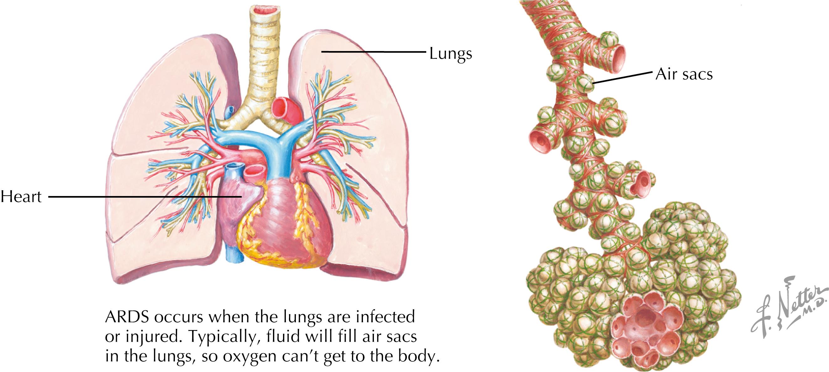 Fig. 95.1, Mechanism of acute respiratory distress syndrome.