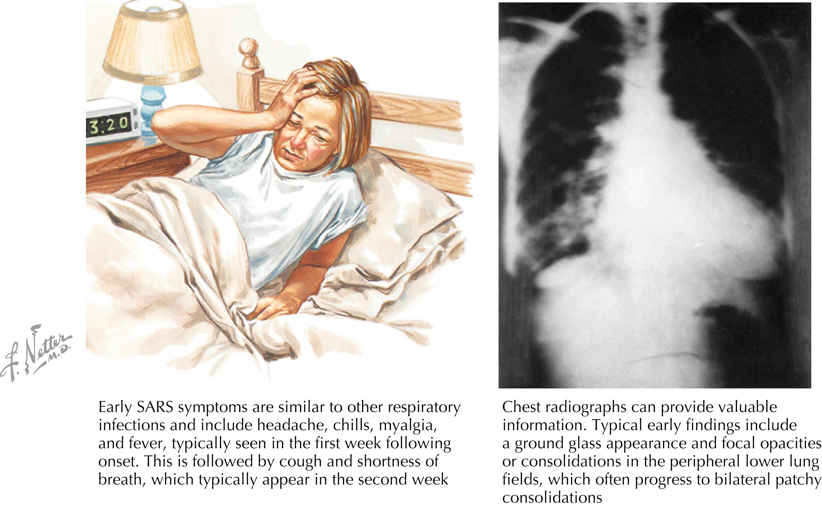 Fig. 95.2, Symptoms of severe acute respiratory syndrome.