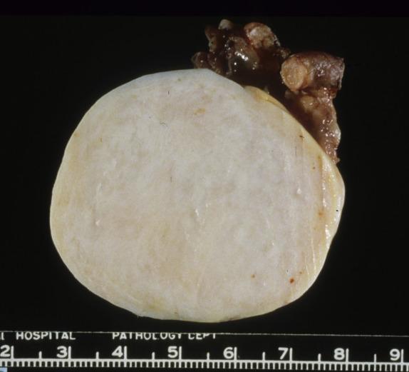 FIG. 15.1, Fibroma. The tumor is well circumscribed with a smooth surface and homogeneous white cut section.