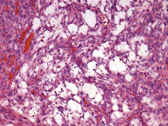 FIG. 15.11, Luteinized thecoma with sclerosing peritonitis. Marked edema of the ovarian tumor produces microcyst formation.