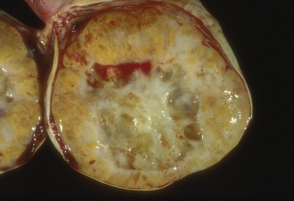 FIG. 15.13, Sclerosing stromal tumor. The tumor is characteristically well circumscribed with a tan to yellow solid cut surface; some tumors may show central cyst formation.