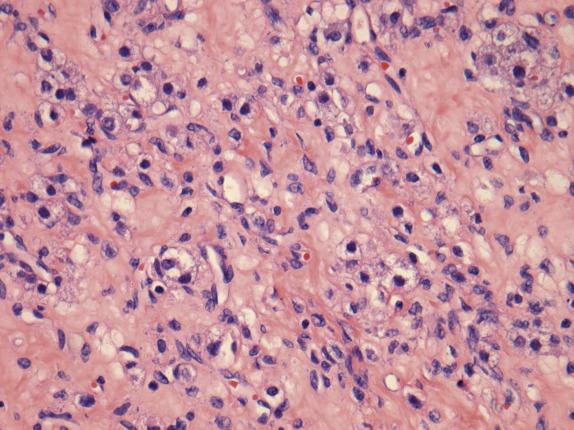 FIG. 15.15, Sclerosing stromal tumor. The tumor is composed of an admixture of spindle cells and round luteinized cells.