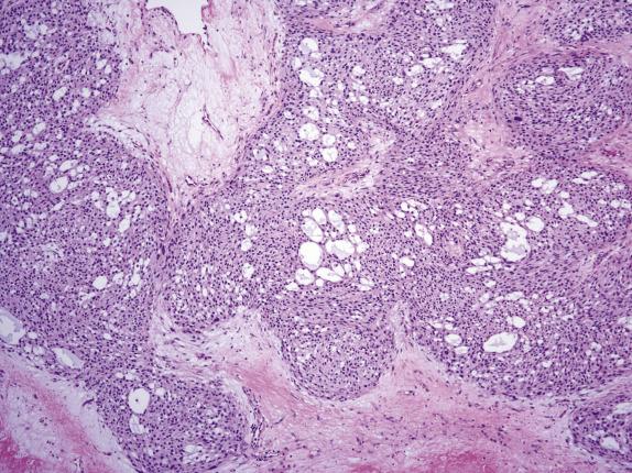 FIG. 15.16, Microcystic stromal tumor. Irregular anastomosing islands of tumor cells show microcystic change. Notice the presence of collagenous bands (bottom of picture).