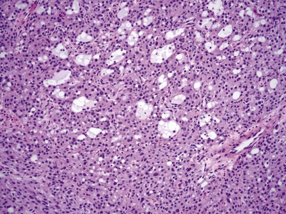 FIG. 15.17, Microcystic stromal tumor. Multiple small cysts filled with clear to lightly basophilic secretions are surrounded by aggregates of cells with abundant eosinophilic cytoplasm. Multiple intracytoplasmic vacuoles are present (bottom left) .