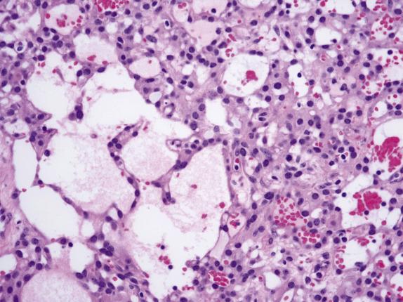 FIG. 15.19, Microcystic stromal tumor. The cells show eosinophilic to finely granular cytoplasm and round to slightly oval nuclei with tiny nucleoli.