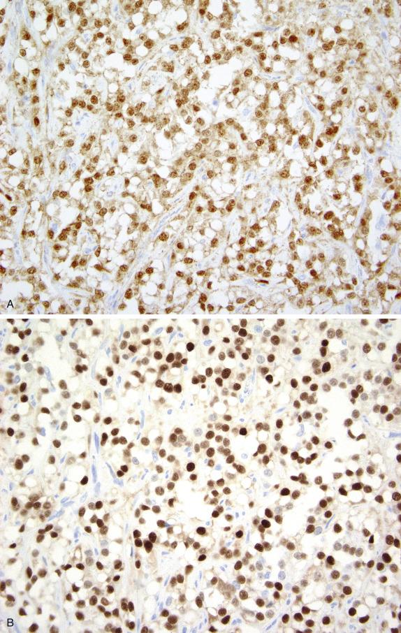 FIG. 15.20, Microcystic stromal tumor. The tumor cells show strong and diffuse nuclear positivity for beta-catenin (A) and cyclin D1 (B).