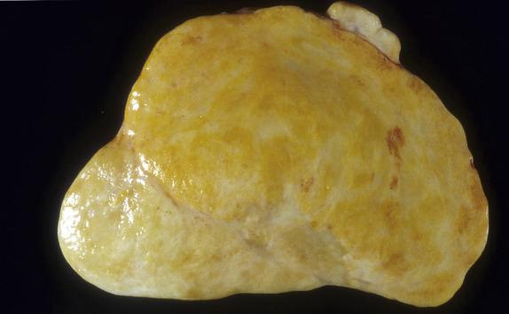 FIG. 15.2, Cellular fibroma. The tumor is uniformly tan to yellow, except in the lower left portion, where it shows the more conventional white appearance of a fibroma.