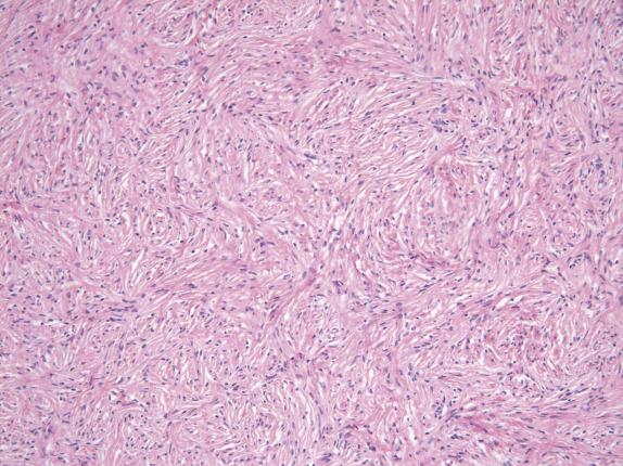 FIG. 15.3, Fibroma. The tumor is composed of short fascicles of bland spindle cells displaying a striking storiform arrangement.