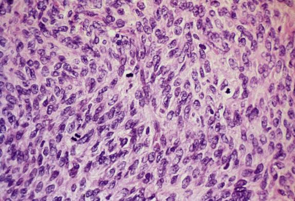 FIG. 15.5, Mitotically active cellular fibroma. An increased mitotic rate is seen in the absence of cytologic atypia.