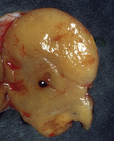 FIG. 15.6, Thecoma. The tumor has a solid, tan to yellow cut surface.