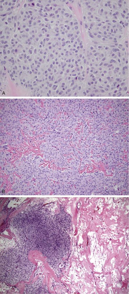 FIG. 15.7, Thecoma. The tumor is composed of spindle to plump cells with pale grey to vacuolated cytoplasm (A). Irregular hyaline plaques (B) and keloid-like sclerosis (C) can be observed.