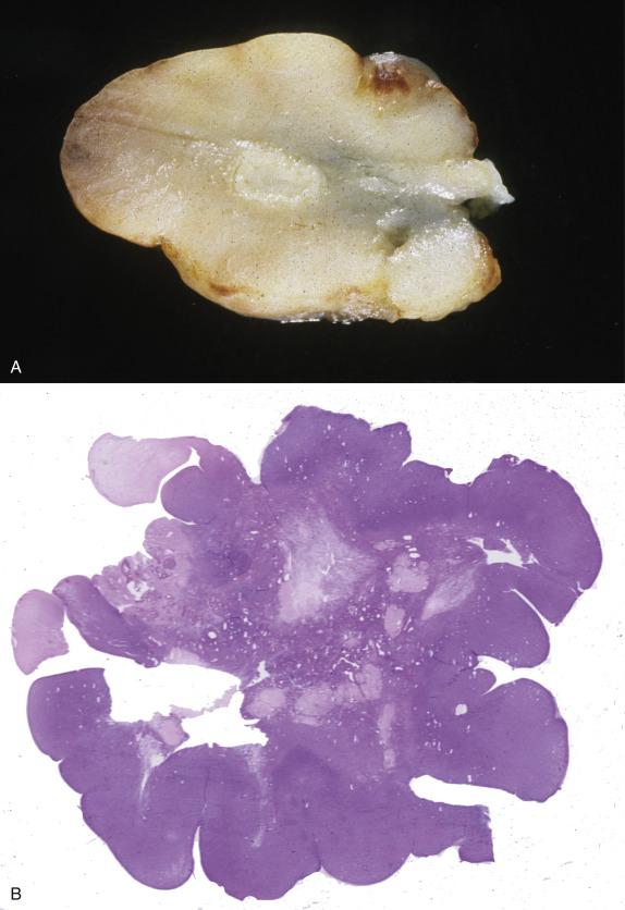 FIG. 15.8, Luteinized thecoma with sclerosing peritonitis. The ovary can be slightly enlarged (A) or have a multinodular growth involving the cortex (B).