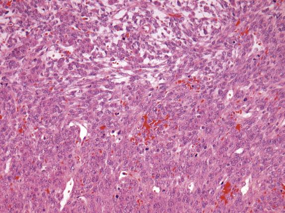 FIG. 15.9, Luteinized thecoma with sclerosing peritonitis. The ovarian tumor is composed of dense short intersecting fascicles of spindle cells with scanty eosinophilic cytoplasm and round to spindled nuclei with small nucleoli, minimal cytologic atypia, and prominent mitotic activity.