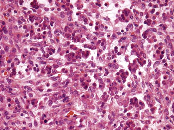 FIG. 15.10, Luteinized thecoma with sclerosing peritonitis. Interspersed between the spindled cells, there are nests and clusters of small luteinized cells.