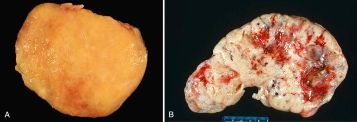 Fig. 27.11, Cellular fibroma and fibrosarcoma. A, In contrast to conventional fibroma, a cellular fibroma is more likely to be tan to yellow and have a softer consistency. B, Fibrosarcomas frequently have foci of hemorrhage or necrosis.