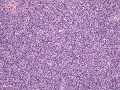 Fig. 27.12, A, Cellular fibroma and fibrosarcoma. Cellular fibroma is hypercellular but maintains its storiform growth pattern. B, At high power (40×), mitoses are readily identified, but atypia is minimal. C, Fibrosarcoma, with increased nuclear atypia and mitoses.