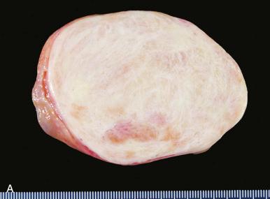 Fig. 27.7, Gross appearance of ovarian fibroma. A, Conventional appearance is that of a smooth, well-circumscribed mass with a firm consistency and white to tan appearance on sectioning. B, Multinodular involvement of ovary in a patient with Gorlin syndrome.