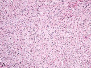 Fig. 27.8, Fibroma. A, The tumor is characteristically composed of spindled stromal cells, fibroblasts, and abundant collagen matrix. B, Hyaline bands may be present.