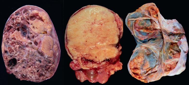 Fig. 16.1, Adult granulosa cell tumor, varied gross characteristics. Left: Most common is a solid and cystic sectioned surface with the cysts often containing blood. Middle: A uniformly solid yellow appearance is occasionally encountered. Right: Least common is a purely or dominantly cystic tumor in which the cysts may be smooth lined or may contain foci of solid neoplastic growth.