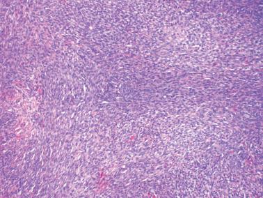 Fig. 16.11, Adult granulosa cell tumor. A conspicuous spindle cell (sarcomatoid) pattern is present. A reticulin stain can be crucial in demonstrating an epithelial nature in such regions.