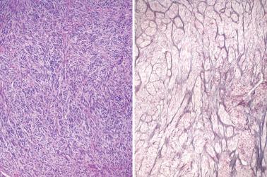 Fig. 16.12, Adult granulosa cell tumor. This tumor has a conspicuous fibromatous appearance but subtle evidence of epithelial differentiation is evident on H&E (left) and is highlighted by a reticulin stain (right).