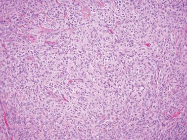 Fig. 16.14, Adult granulosa cell tumor. The neoplastic granulosa cells have appreciable pale cytoplasm, reminiscent of a thecoma. However, a reticulin stain showed a nested pattern.