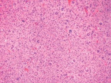 Fig. 16.15, Adult granulosa cell tumor. This neoplasm contained bizarre nuclear atypia. Note the lack of mitotic figures and background of more typical neoplastic granulosa cells.