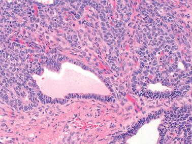 Fig. 16.16, Adult granulosa cell tumor. Tubular differentiation that appears gland like, an uncommon feature, is demonstrated.