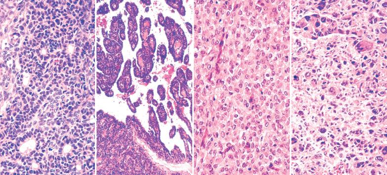 Fig. 16.17, Adult granulosa cell tumor, unusual findings. Left: Scattered small tubules. Left center: Pseudopapillary pattern. Right center: Luteinized cells, resulting in a superficial resemblance to a steroid cell tumor, although cytoplasm is not as conspicuous, nuclei are more angulated, and nucleoli are less prominent. Nuclear grooves are not conspicuous but nuclei have typical pale appearance of granulosa cell tumor. Right: Tumor cells with bizarre nuclei.