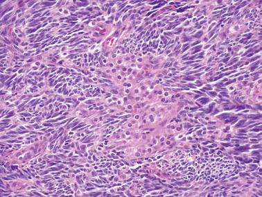 Fig. 16.18, Adult granulosa cell tumor. A large aggregate of luteinized stromal cells is seen (center).