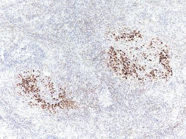 Fig. 16.20, Adult granulosa cell tumor. An inhibin stain highlights two islands of granulosa cells in a neoplasm that had a prominent fibrothecomatous stroma. There is focal less intense staining of the background stromal cells.