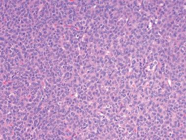 Fig. 16.2, Adult granulosa cell tumor. Typical diffuse growth of cells with relatively scant cytoplasm and monotonous appearance.