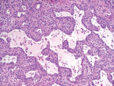 Fig. 16.23, Juvenile granulosa cell tumor. Two characteristic features of this neoplasm are seen: follicles that vary in size and shape and neoplastic cells with abundant eosinophilic cytoplasm.