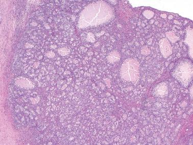 Fig. 16.24, Juvenile granulosa cell tumor. Numerous variably sized and cystically dilated follicles with eosinophilic secretions are seen.