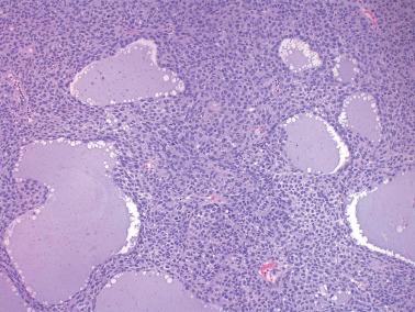 Fig. 16.25, Juvenile granulosa cell tumor. A cellular growth of neoplastic granulosa cells is punctuated by variably size follicles that contain somewhat basophilic secretions.