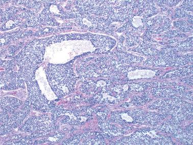 Fig. 16.26, Juvenile granulosa cell tumor. There is a markedly irregular follicular pattern and solid nests of cells.