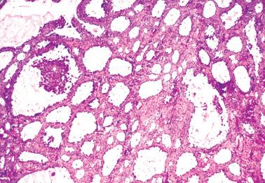 Fig. 16.27, Juvenile granulosa cell tumor. Many follicles are dilated, imparting a striking cystic appearance.