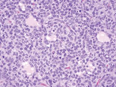 Fig. 16.29, Juvenile granulosa cell tumor. Note the somewhat hyperchromatic nuclei with several mitotic figures. A few small follicles are also seen. The tumor cells in this tumor have less cytoplasm than is usual.