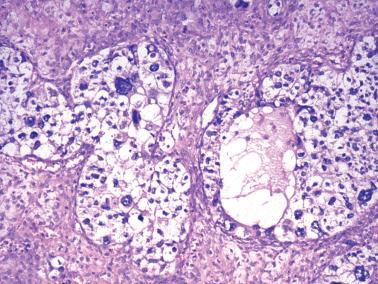 Fig. 16.30, Juvenile granulosa cell tumor. Conspicuous nuclear atypia is present. Note the helpful finding of a follicle.