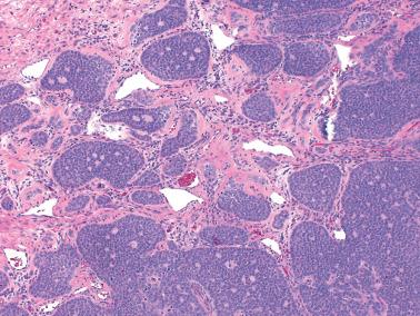 Fig. 16.3, Adult granulosa cell tumor. There is a prominent insular pattern with numerous Call–Exner bodies. Note the prominent vascularity of the stroma.