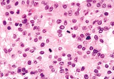 Fig. 16.31, Juvenile granulosa cell tumor. Note conspicuous eosinophilic cytoplasm and mitotic activity.