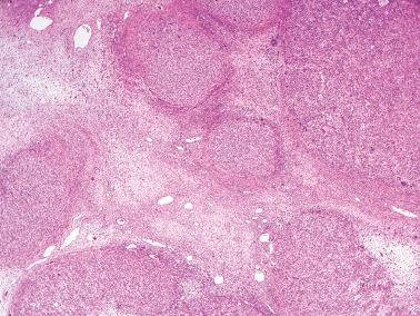 Fig. 16.32, Juvenile granulosa cell tumor. A macronodular pattern with only a few barely perceptible abortive follicles is present.