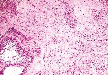 Fig. 16.33, Juvenile granulosa cell tumor. There is extensive sclerosis, an occasional confusing finding in this neoplasm.