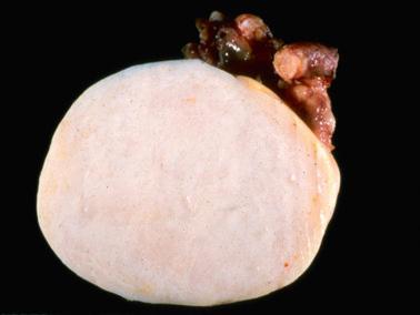 Fig. 16.34, Fibroma. The typical solid white sectioned surface of a fibroma is seen.